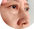 眼瞼下垂