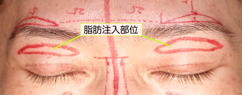 加齢性の眉のたるみと上まぶたのたるみ、陥凹性変形の修正を希望なさった患者さまです。眉上皮伏切除とともに上眼瞼に脂肪を注入手術デザイン