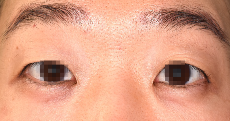 上眼瞼のたるみを眉下皮膚切除と切開重瞼で修正術前開眼