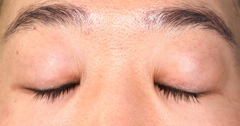 上眼瞼のたるみを眉下皮膚切除と切開重瞼で修正術前閉眼