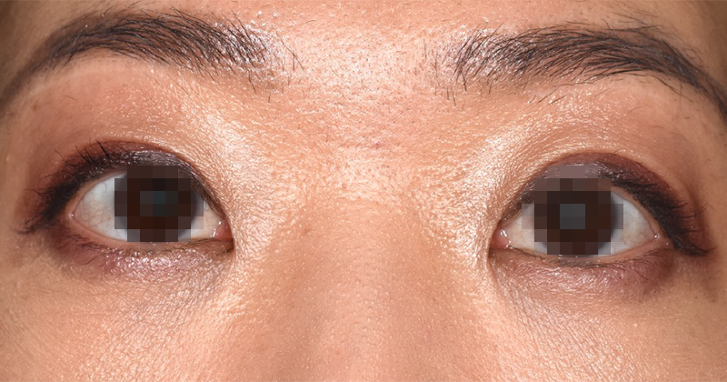 上眼瞼のたるみを眉下皮膚切除と切開重瞼で修正術前開眼