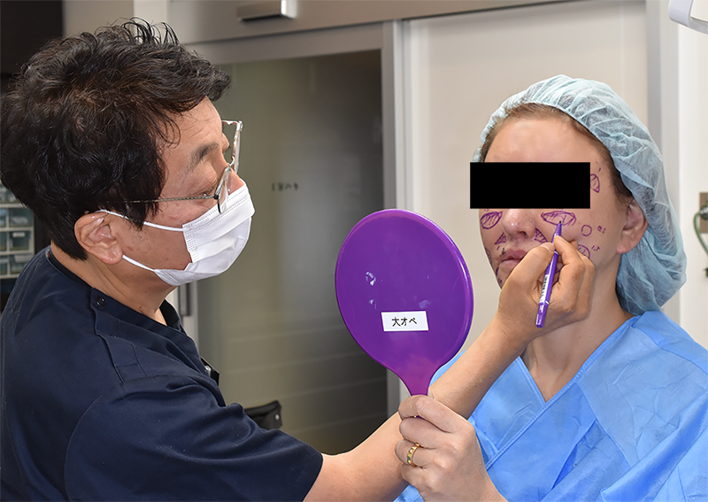手術担当医が患者様の希望部位を聴取しながら脂肪注入部位にマーキングを来ないます。