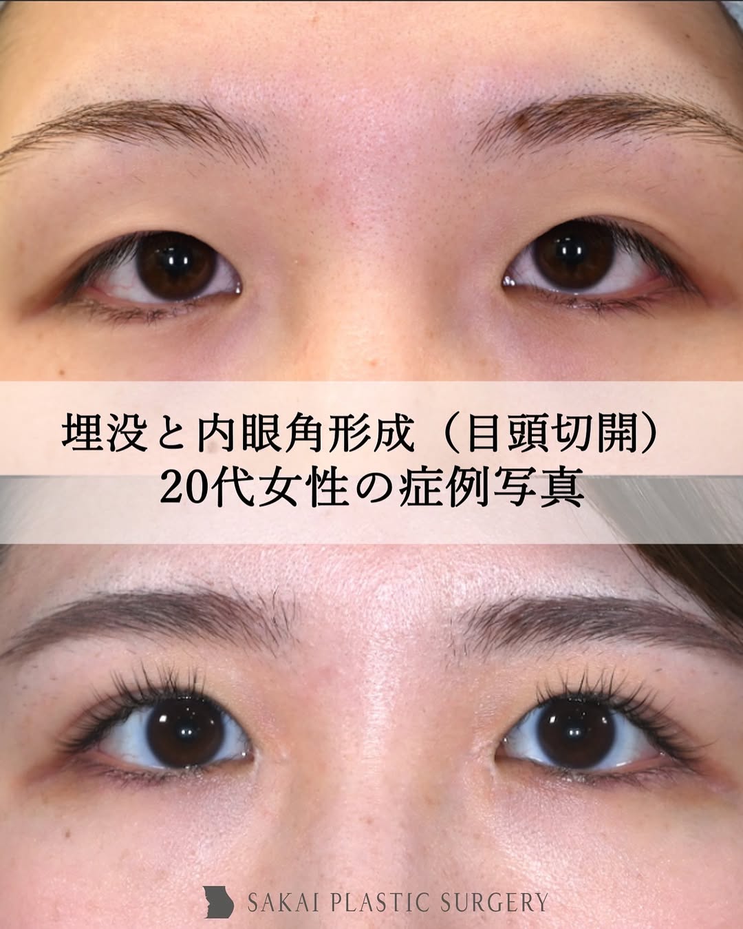 目頭切開1