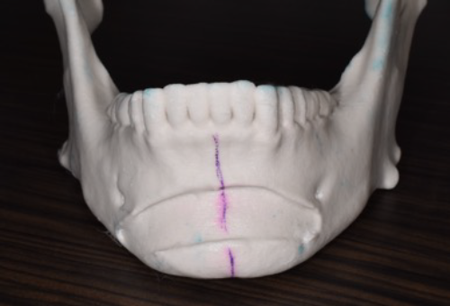 3Dプリンタとクレイモデル(粘土モデル)を使って実際の人工骨を再現1