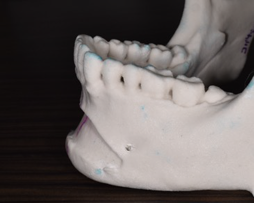 3Dプリンタとクレイモデル(粘土モデル)を使って実際の人工骨を再現2