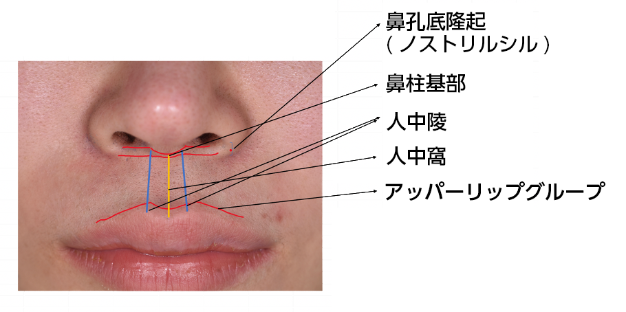 人中短縮手術説明画像1