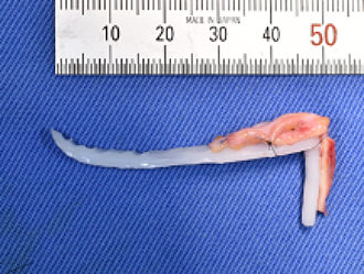 柔らかいシリコーンプロテーゼのの鼻尖部を削り、そこに耳介軟骨と真皮を接着し、コンポジットを作ります。