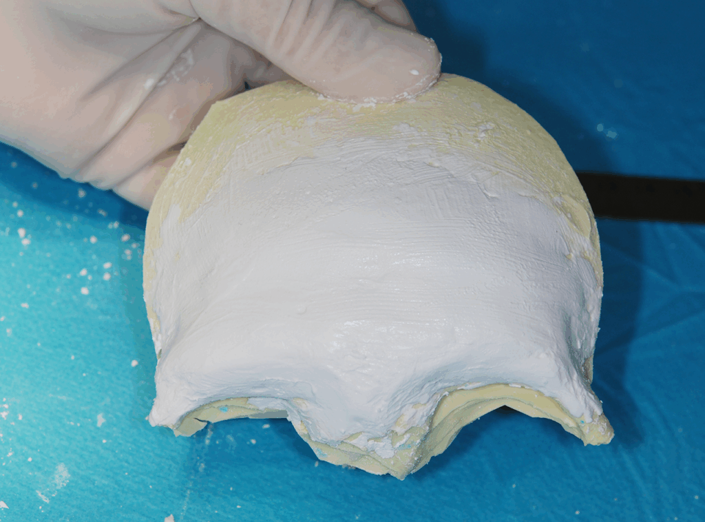 3Dモデルに人工骨を成形しています