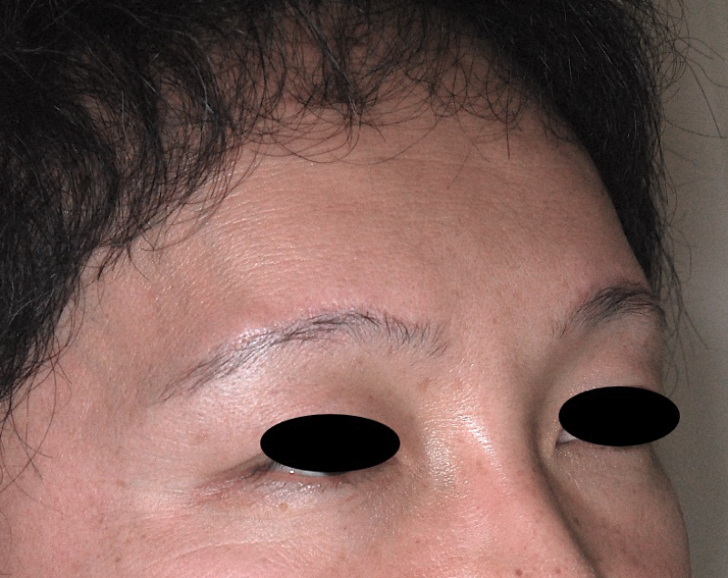前額の骨(前頭骨(おでこ))を綺麗にする手術の症例 術前