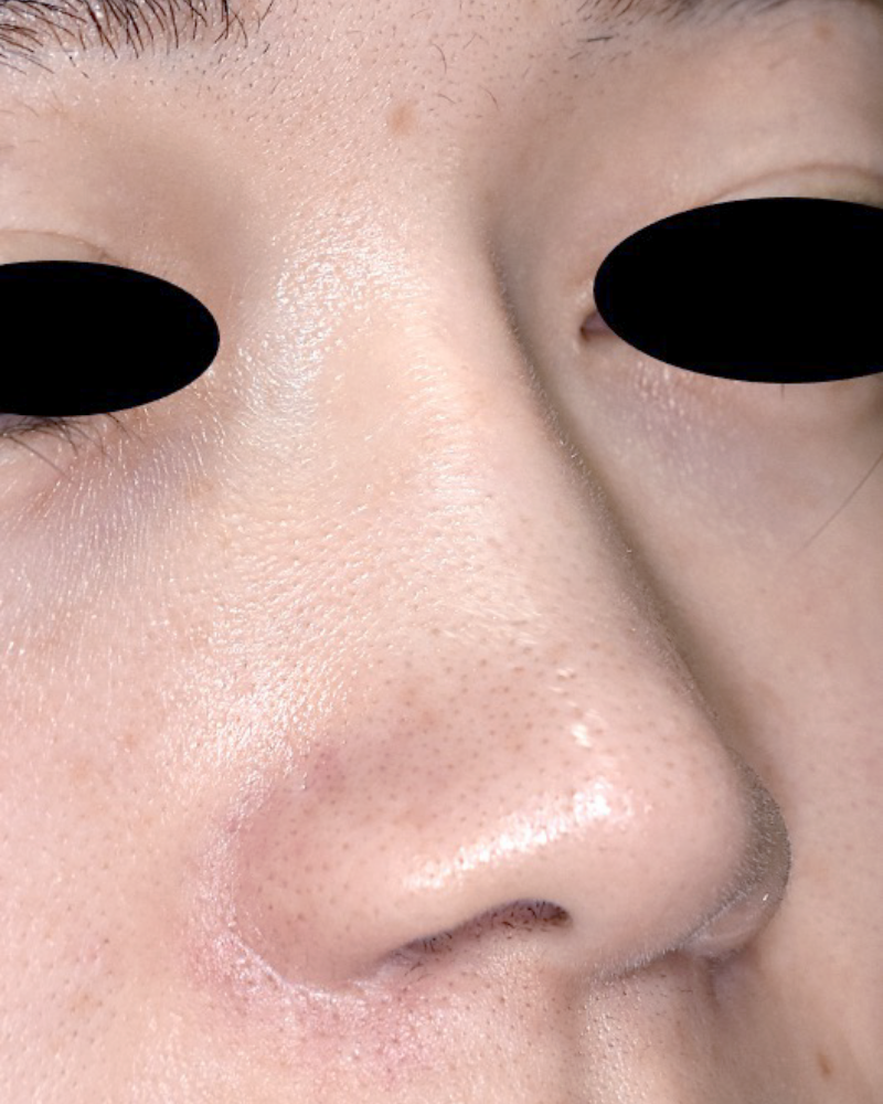 人工骨を使用した劉備術の症例 術後