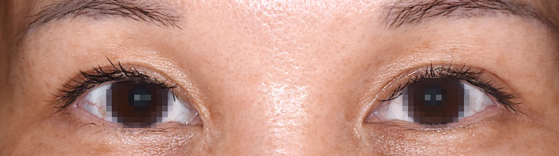 加齢による眼瞼のたるみの修正と瞳を大きくしたい術後 開眼
