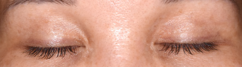 加齢による眼瞼のたるみの修正と瞳を大きくしたい術後 閉眼