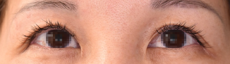 加齢による眼瞼のたるみの修正と瞳を大きくしたい術前 開眼