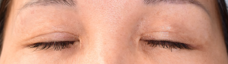 加齢による眼瞼のたるみの修正と瞳を大きくした術前 閉眼