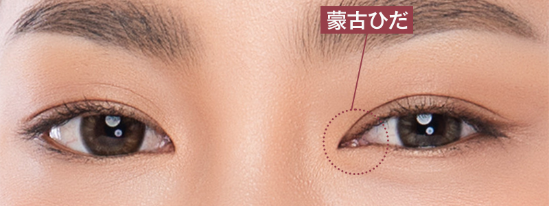 末広型二重まぶたの例