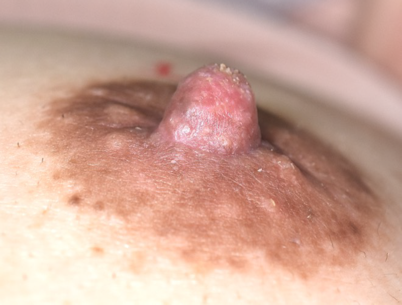 乳頭縮小の症例 術後
