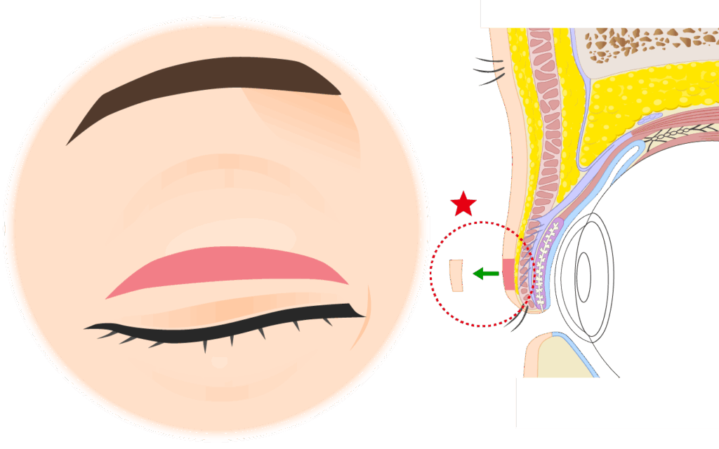 二重幅を少し大きくするため上眼瞼の皮膚を多めに切除
