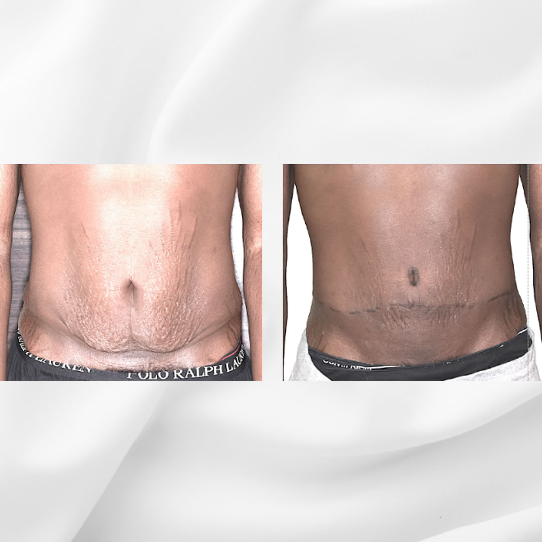 急激なダイエットで腹部に大きな弛みが残った皮膚を切除した症例写真