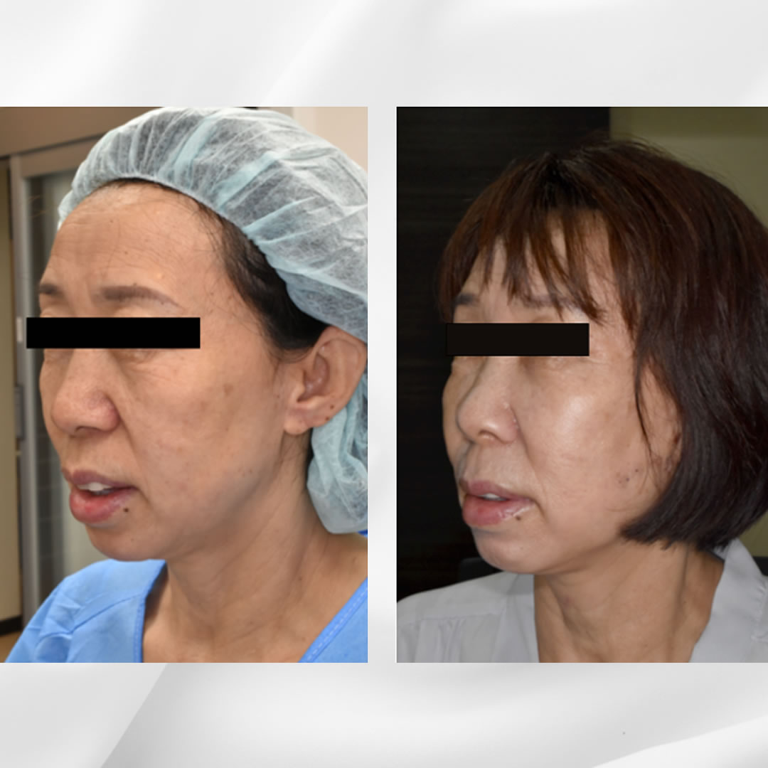 スレッドリフトで中顔面のたるみの改善した症例写真
