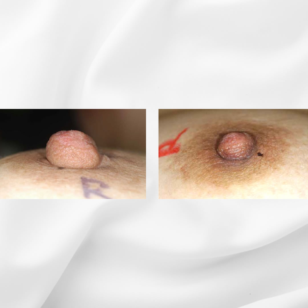 もともと乳頭が大きかったためコンプレクス