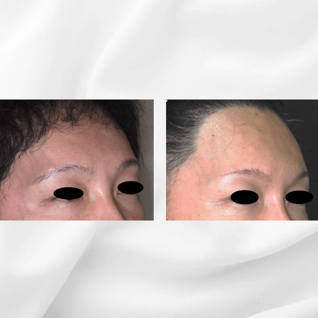 前額ぜんがくと眉骨を突出させたい