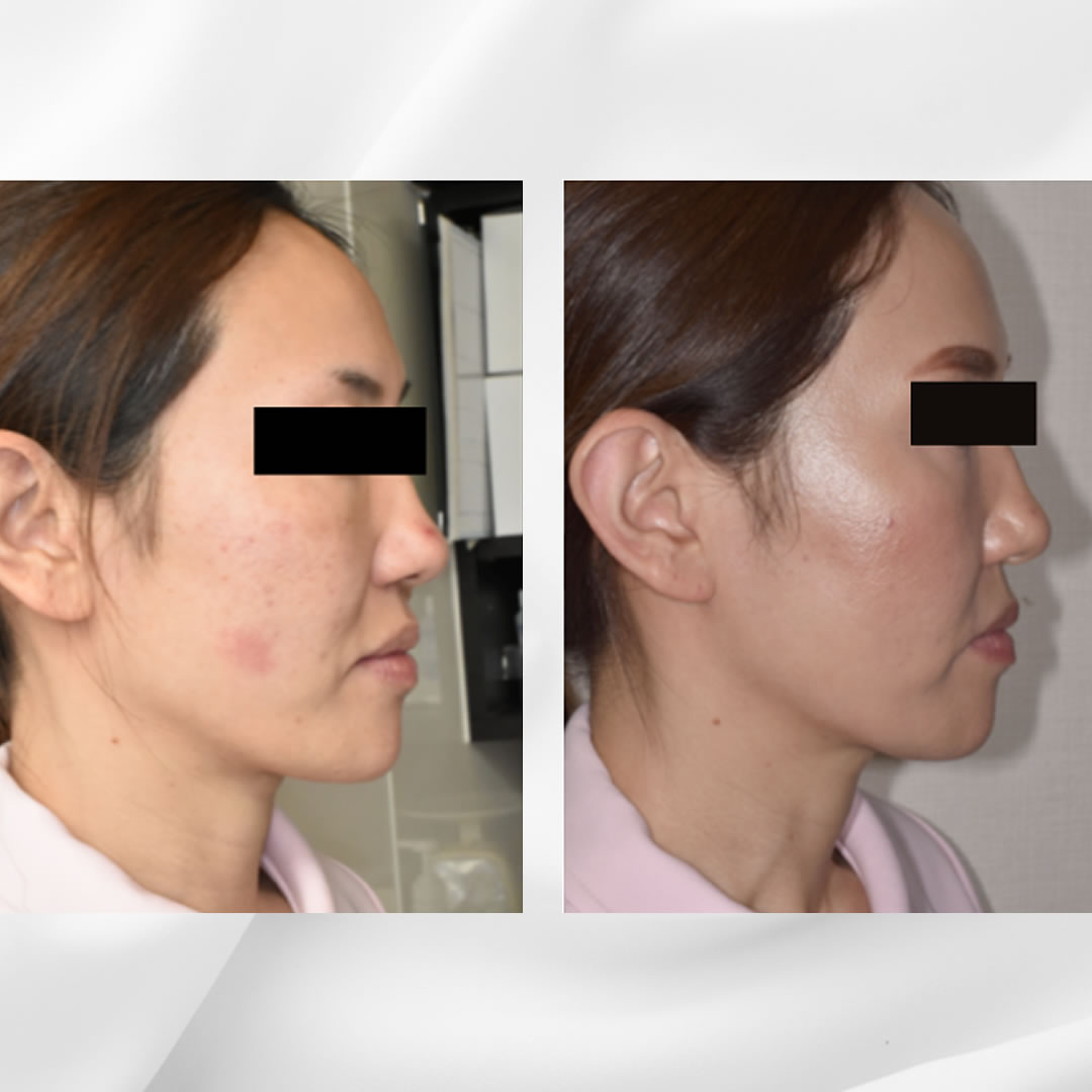 スレッドリフト 顔皮膚の弛みの軽減した症例写真