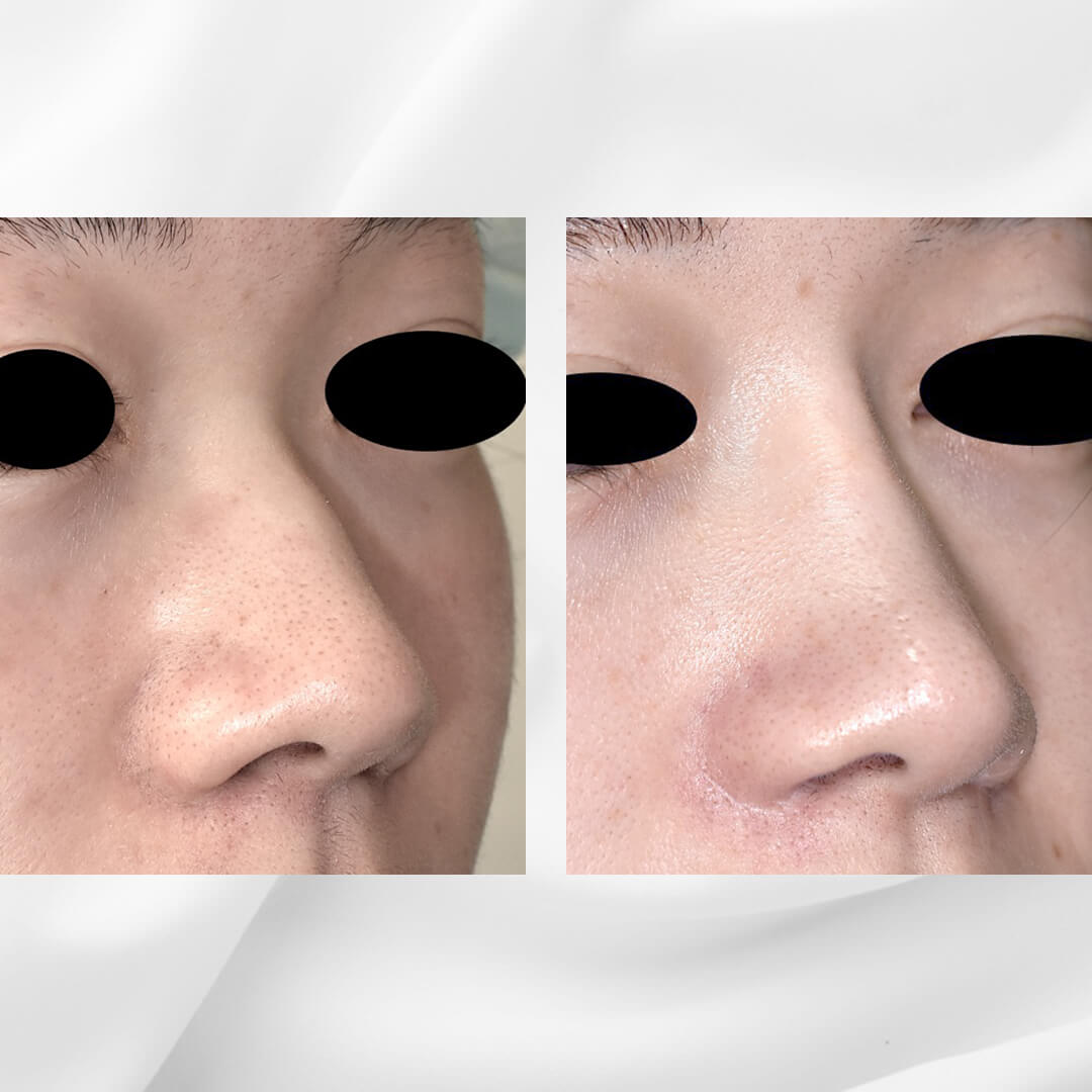 人工骨を使用した隆鼻術の症例