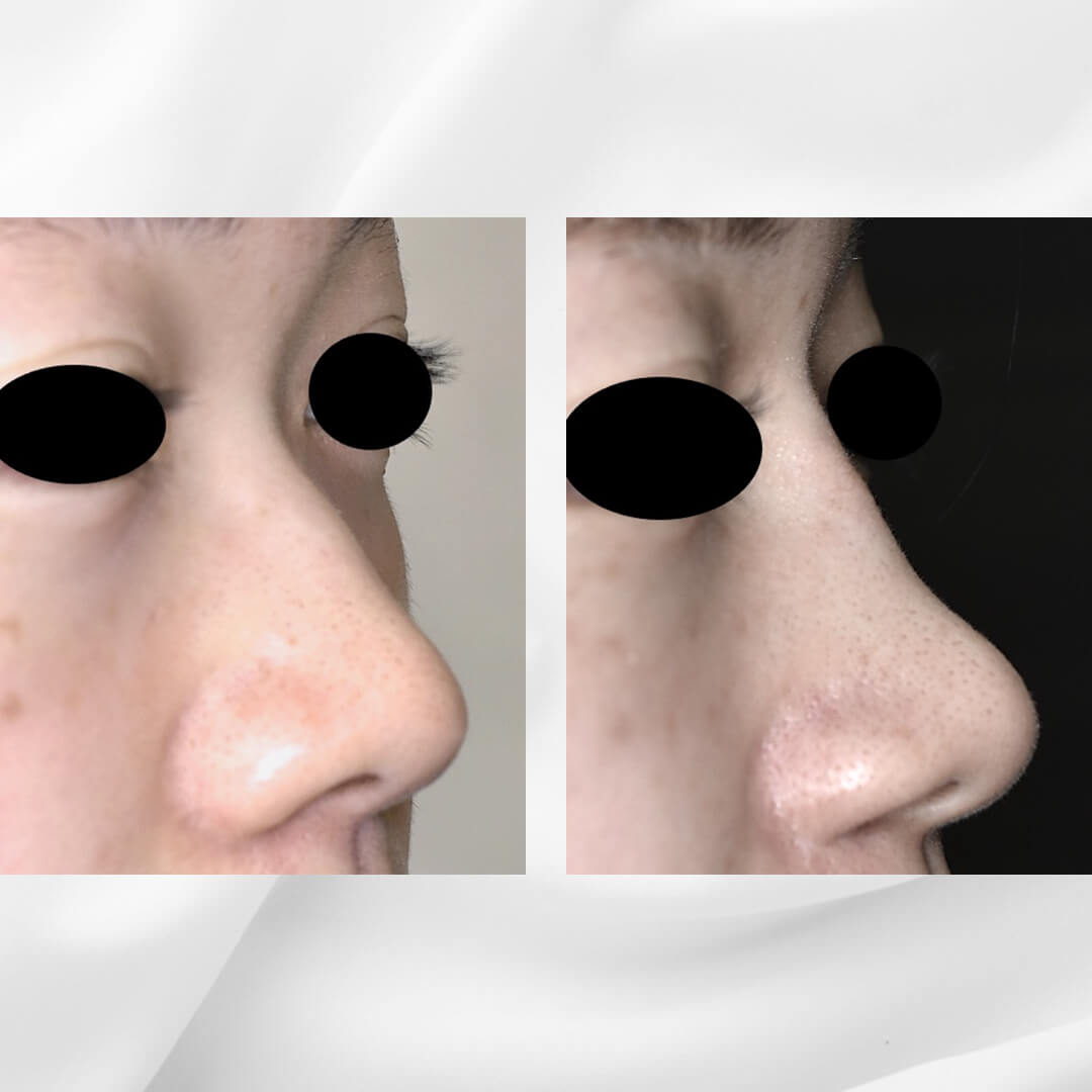 人工骨を使用した隆鼻術の症例