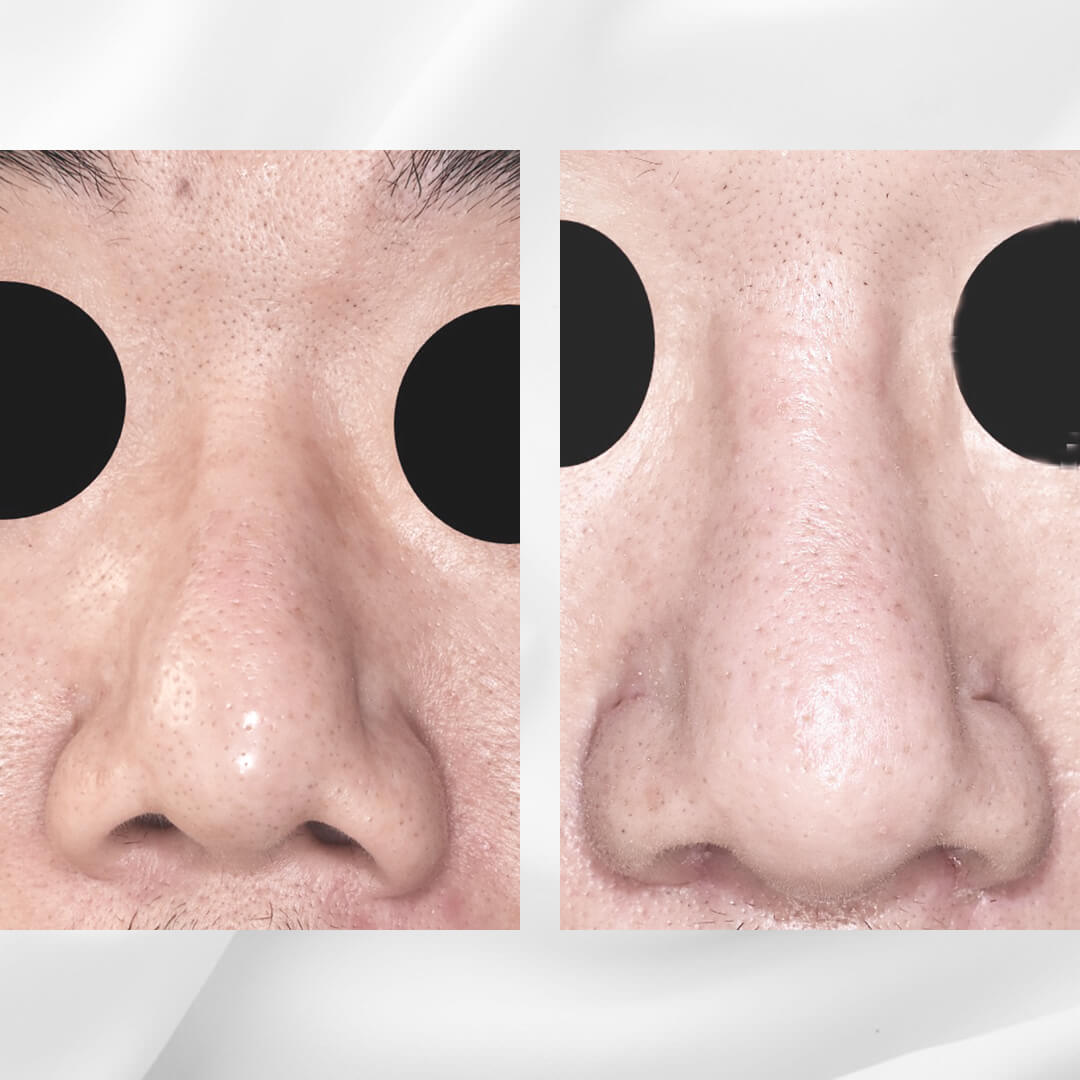 人工骨を使用した隆鼻術の症例