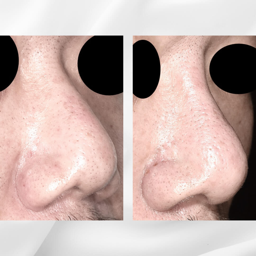 人工骨を使用した隆鼻術の症例
