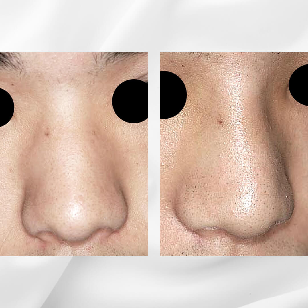 人工骨を使用した隆鼻術の症例