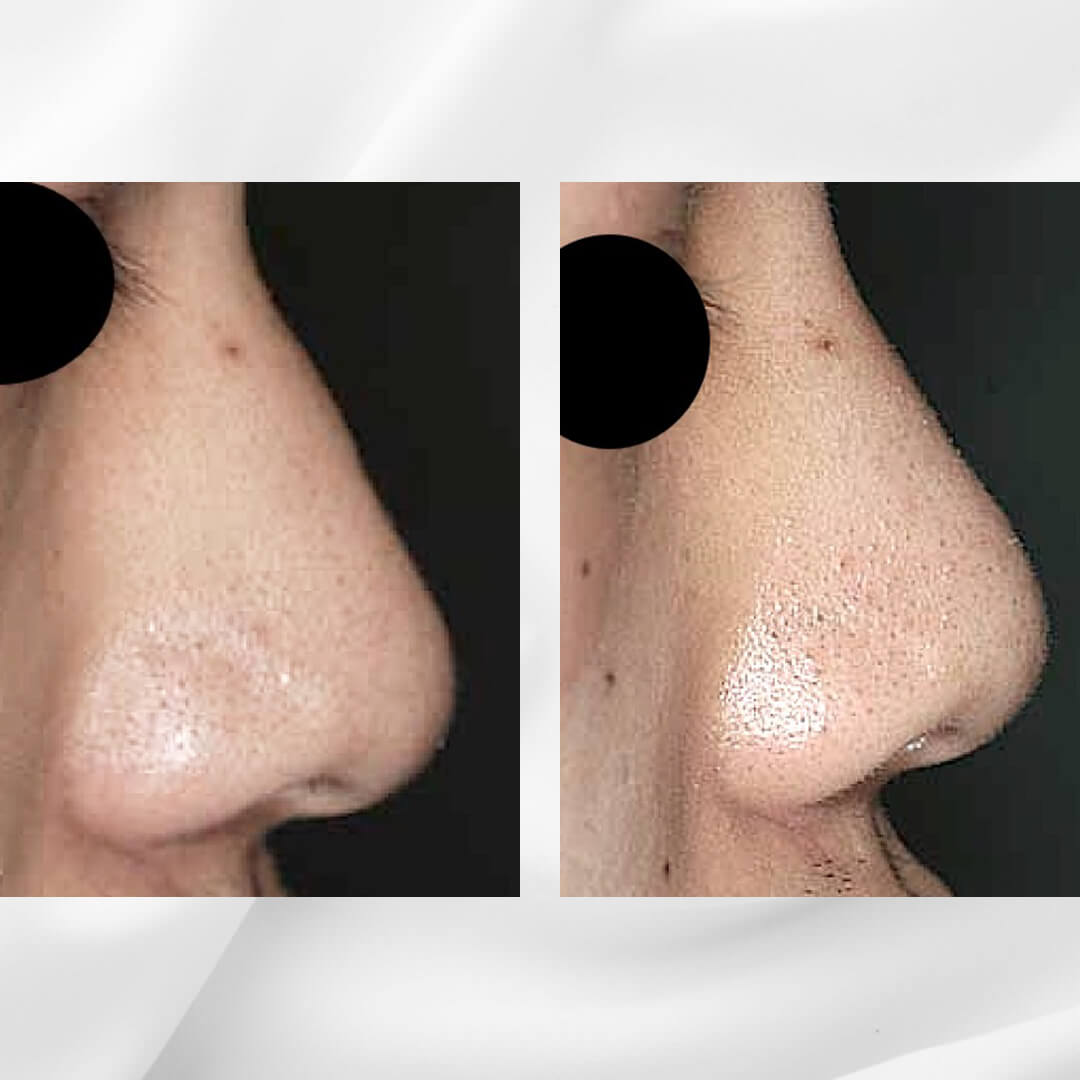 人工骨を使用した隆鼻術の症例