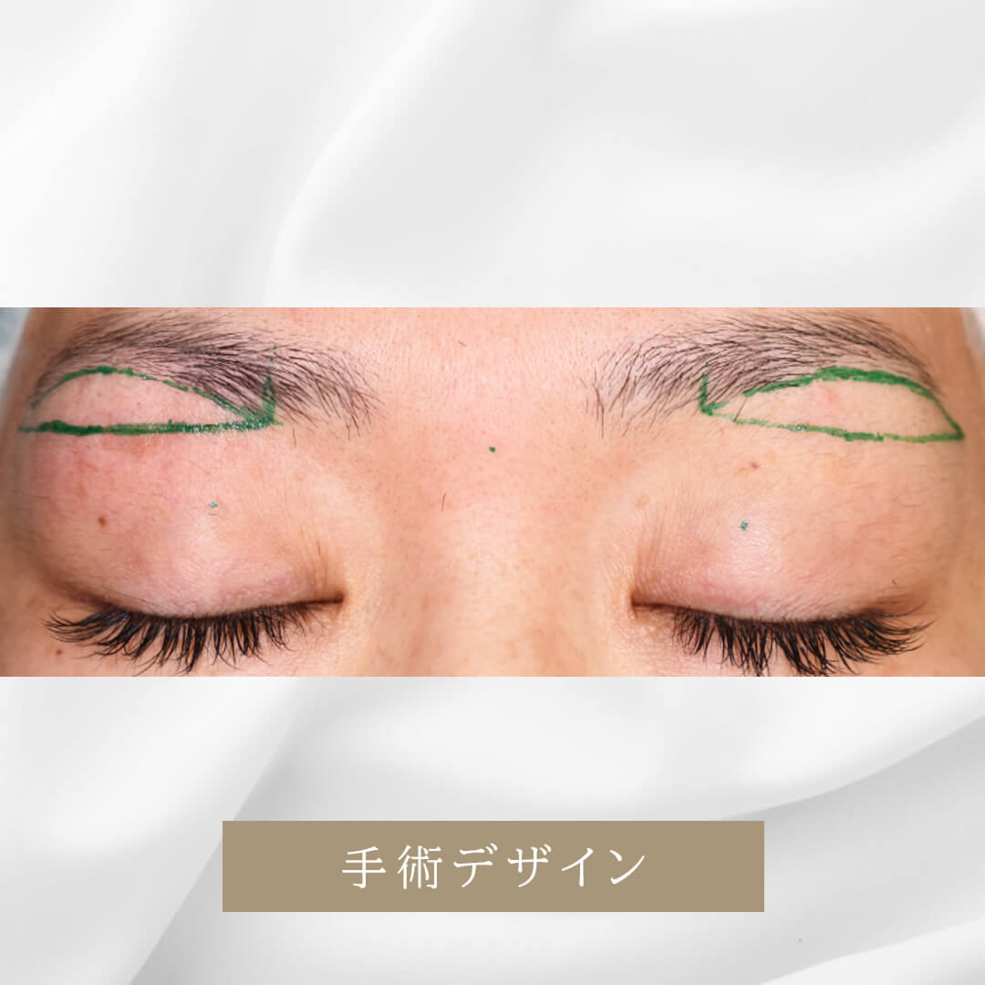 加齢によりまぶたが下がってきた症例　アイリフト
