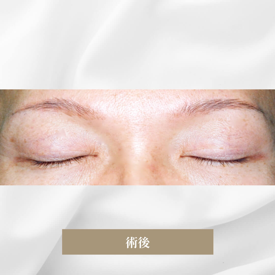 眉形を良くしはっきりした視線の形成　アイリフト