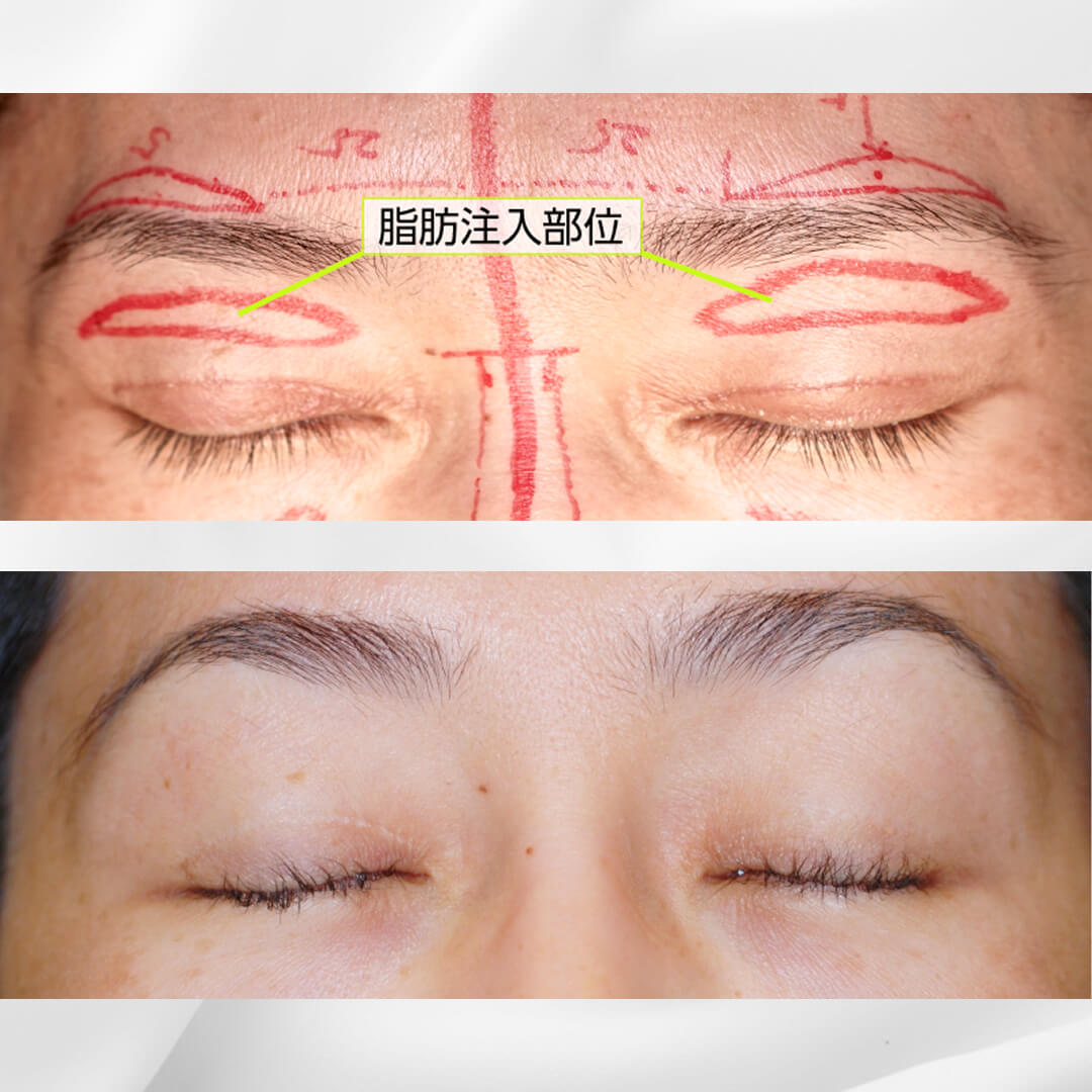 加齢性の眉のたるみと上まぶたのたるみ、陥凹性変形の修正+上眼瞼に脂肪を注入