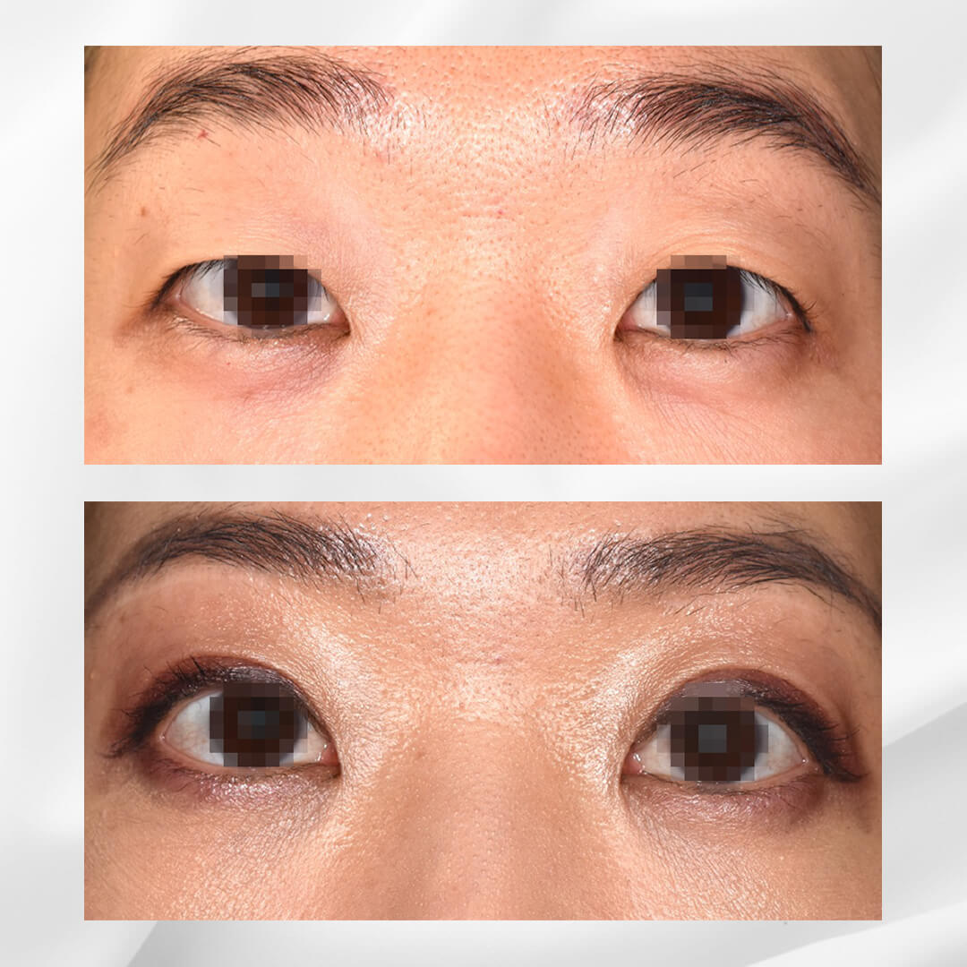 加齢による上眼瞼のたるみを眉下皮膚切除と切開重瞼で修正