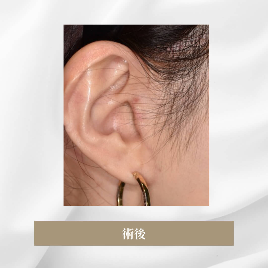 セミトータルフェイスリフト＋脂肪注入