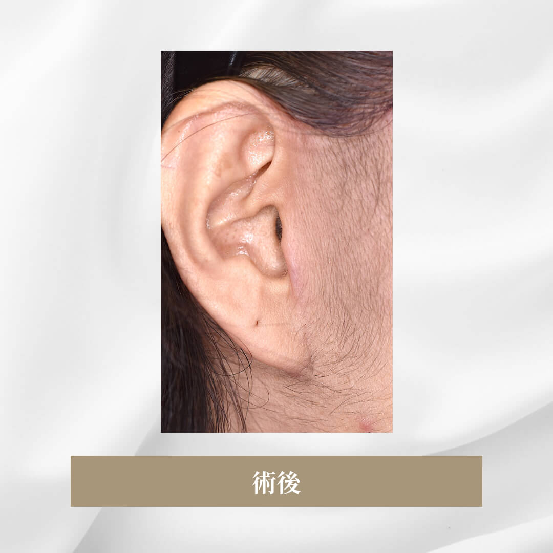 セミトータルフェイスリフトで顔の弛みを矯正