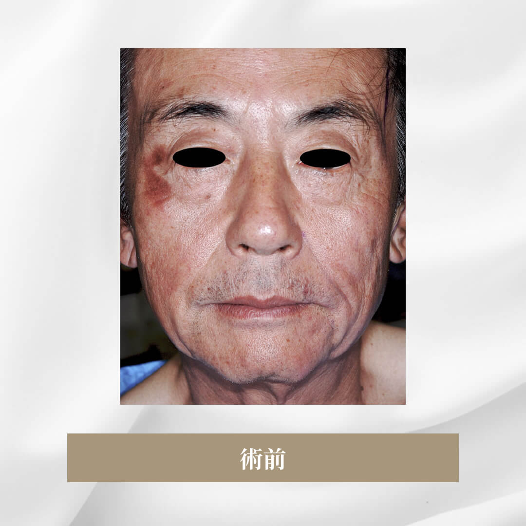 側面側頭のフェイスリフト