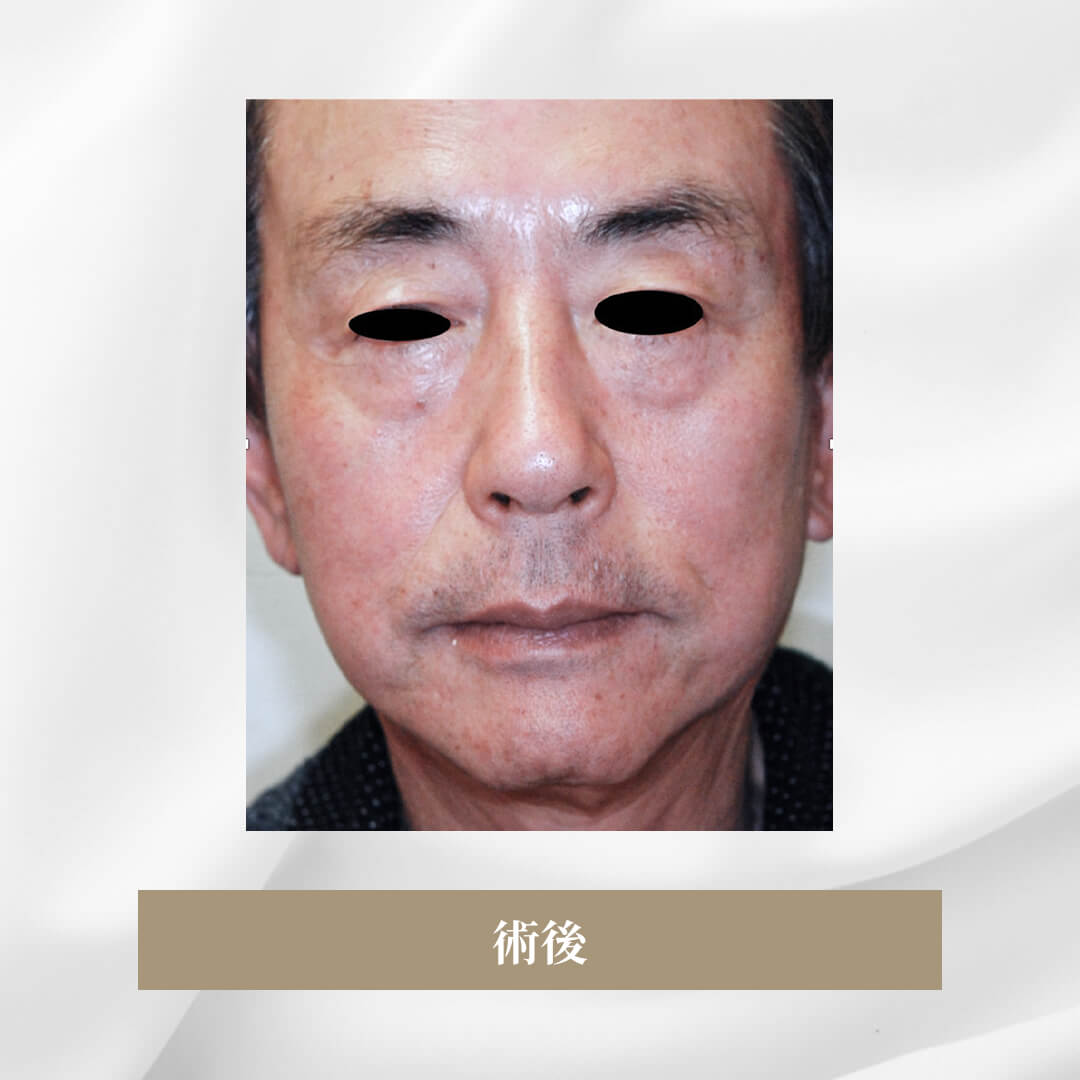 側面側頭のフェイスリフト
