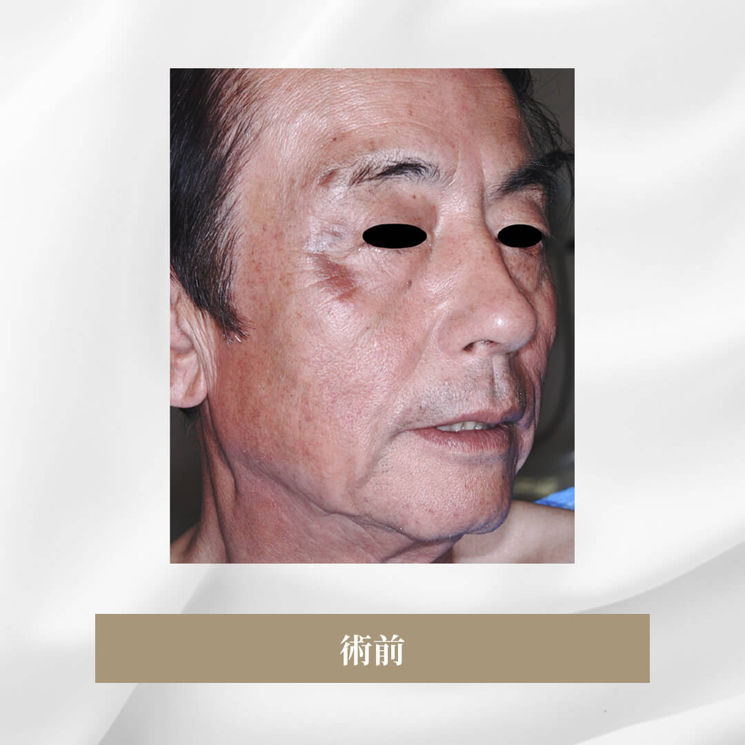 側面側頭のフェイスリフト