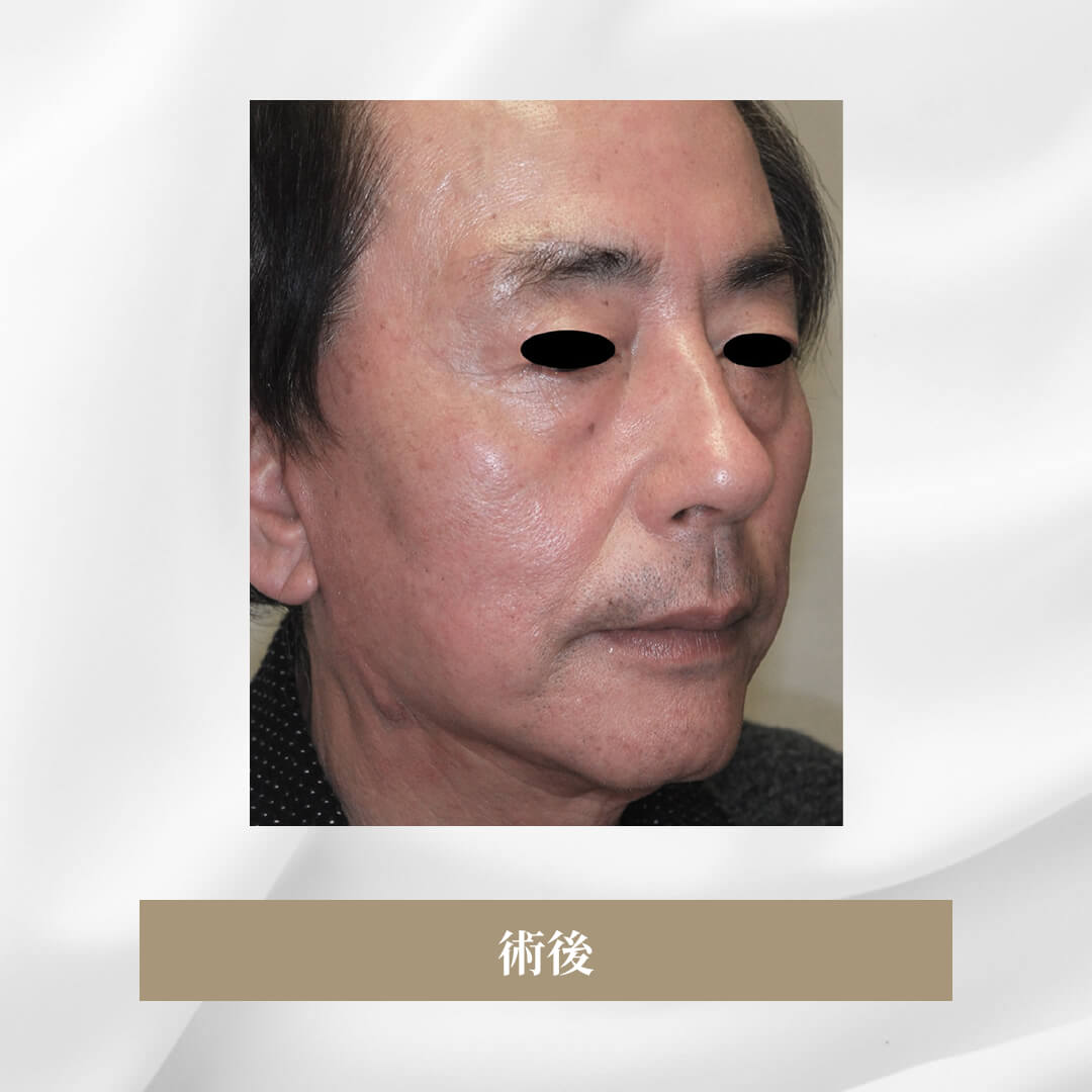 側面側頭のフェイスリフト