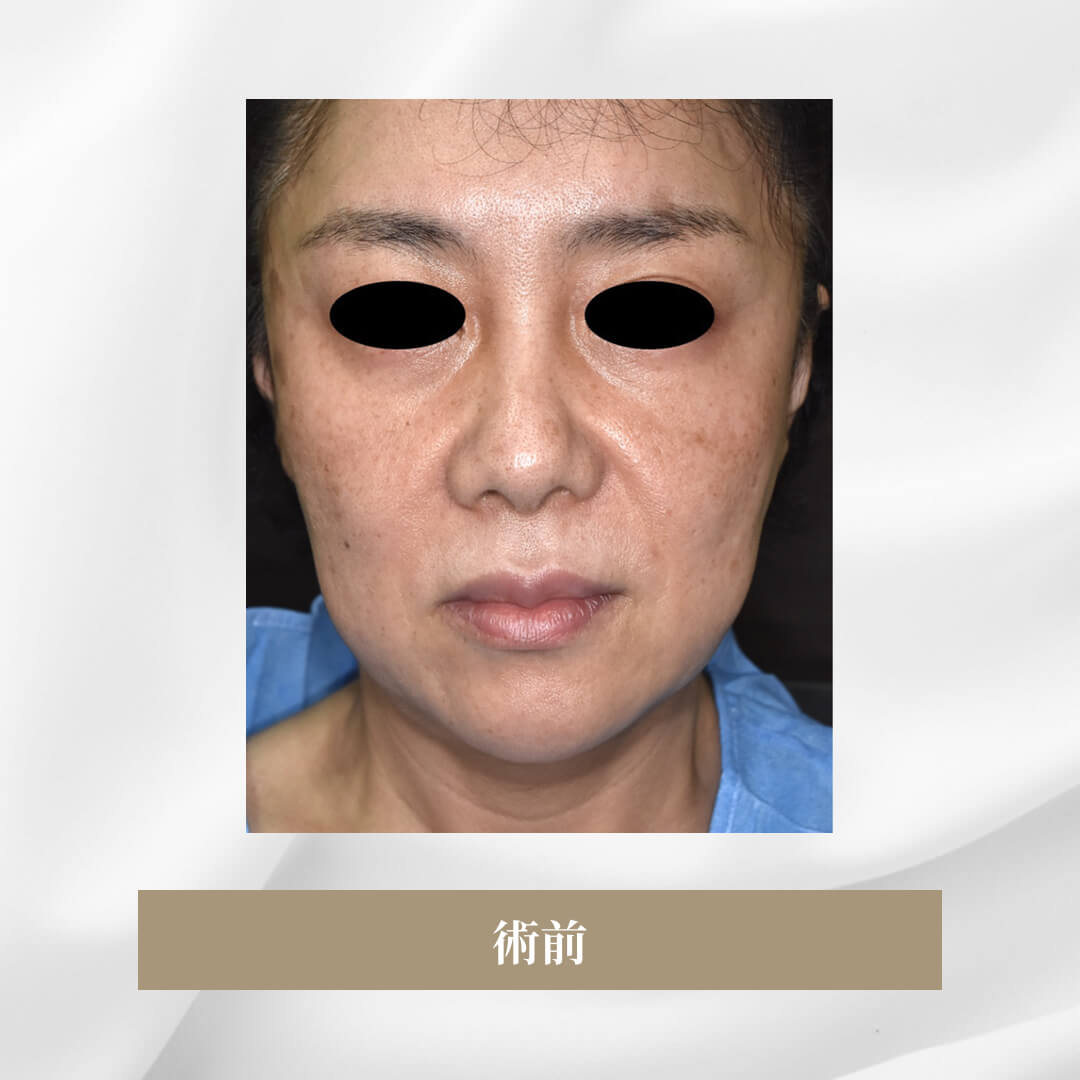 セミトータルフェイスリフトで顔の弛みを矯正