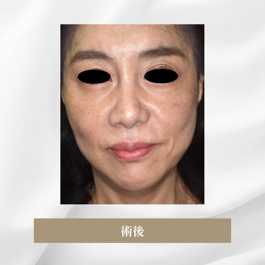 セミトータルフェイスリフトで顔の弛みを矯正