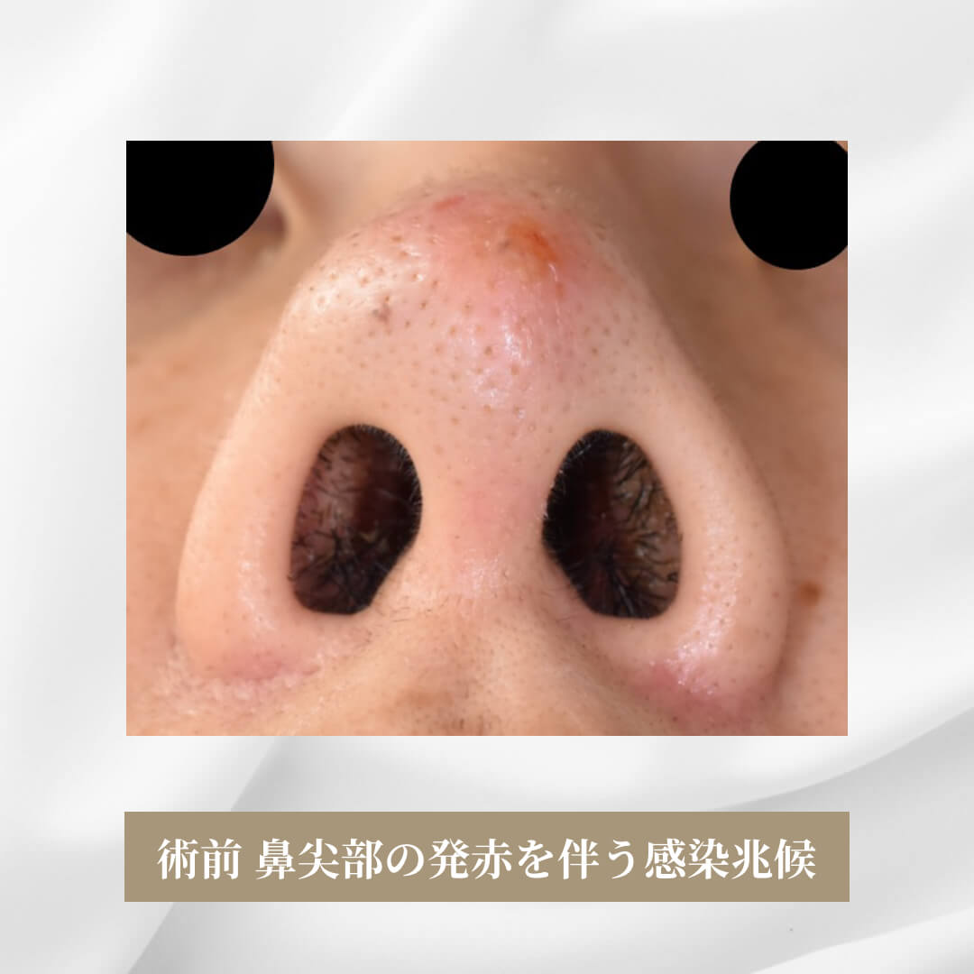 斜鼻変形とプロテーゼの拘縮鼻尖の位置異常の症例