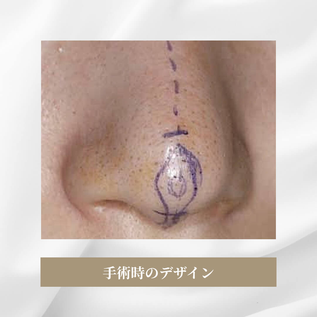 鼻尖軟骨形成の症例
