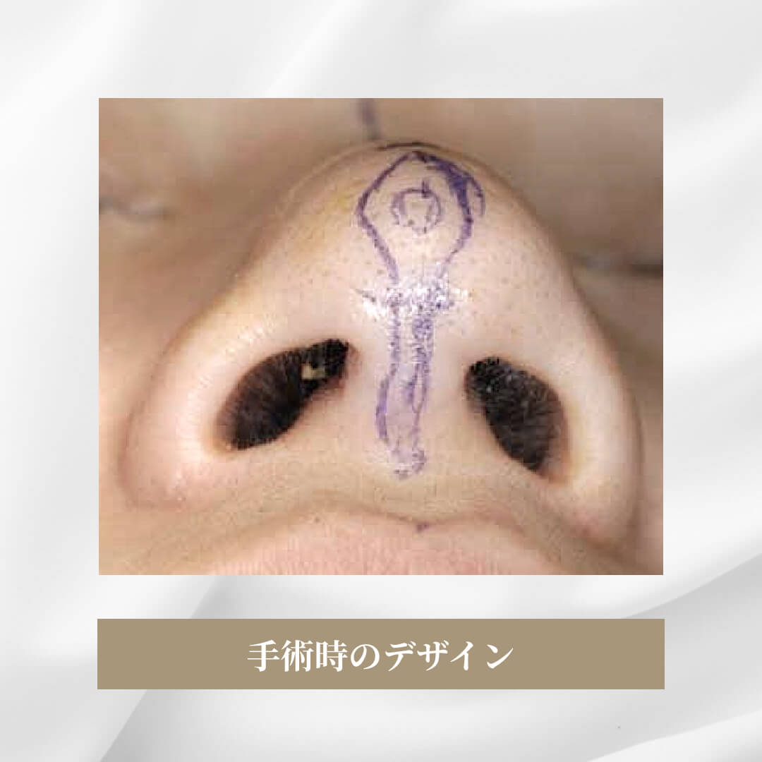 鼻尖軟骨形成の症例