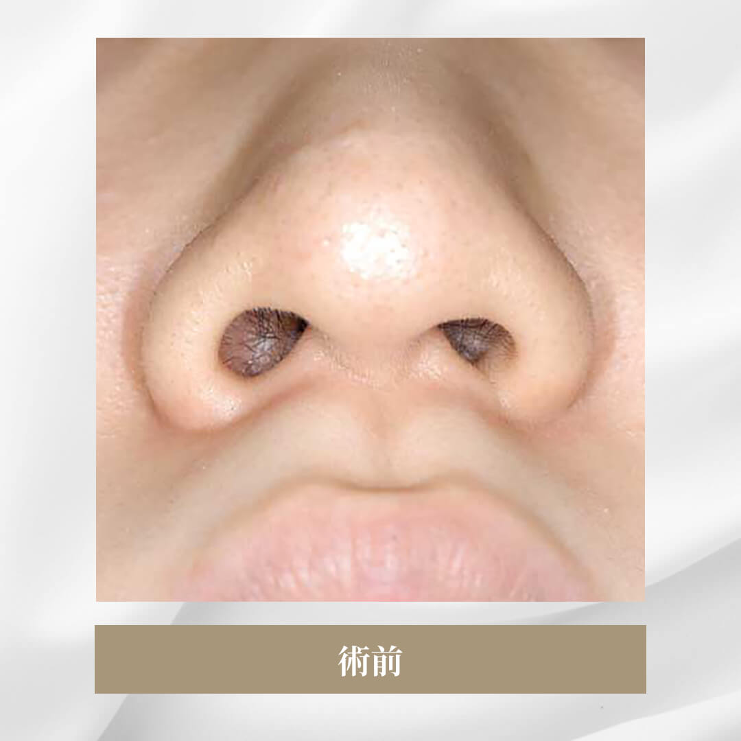 鼻尖軟骨形成の症例