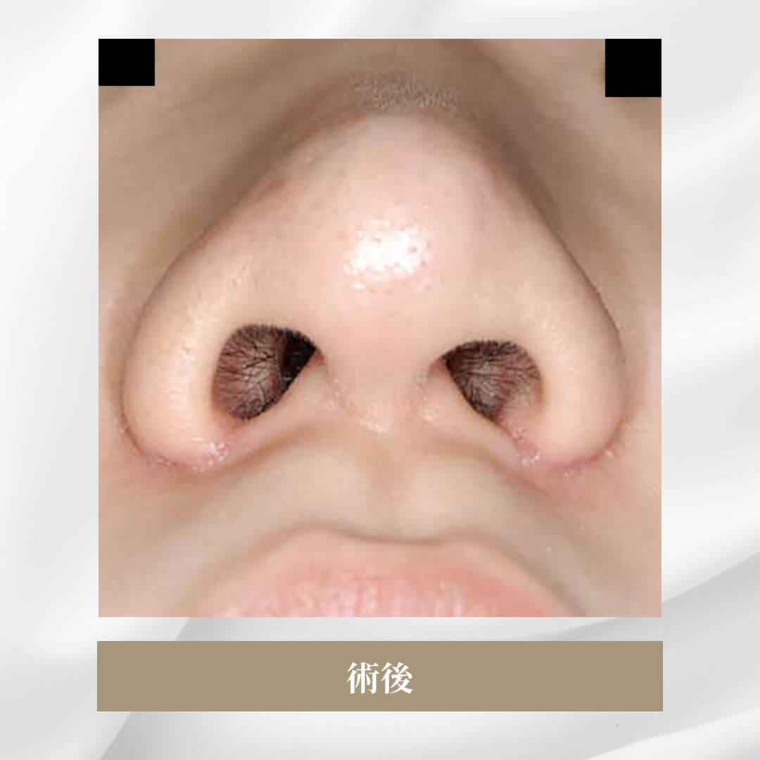 鼻尖軟骨形成の症例