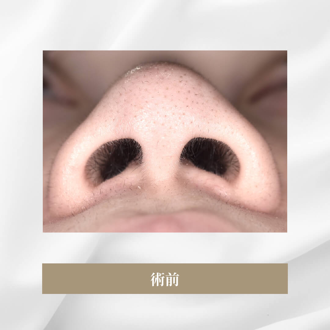 鼻尖軟骨形成の症例